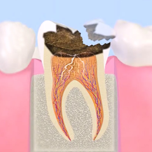 歯髄まで進行したむし歯 （C3）